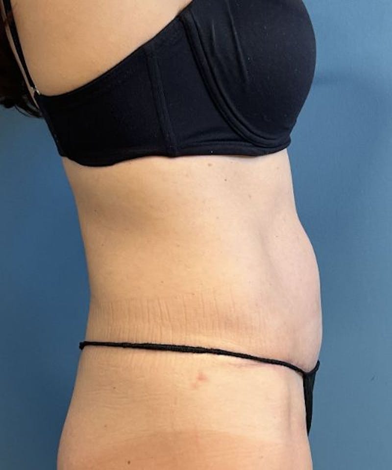 Tummy Tuck Before & After Gallery - Patient 159279 - Image 4