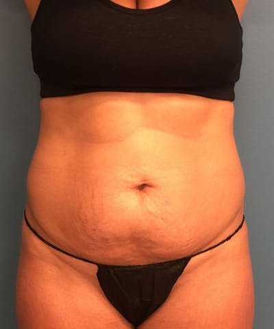 Tummy Tuck Before & After Gallery - Patient 410757 - Image 1