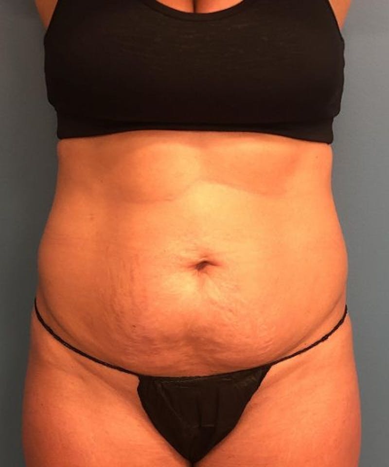 Tummy Tuck Before & After Gallery - Patient 410757 - Image 1