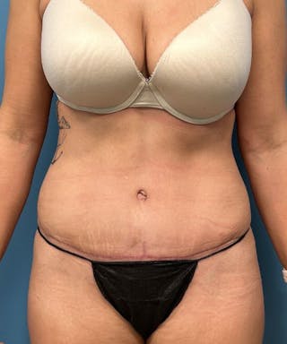 Tummy Tuck Before & After Gallery - Patient 410757 - Image 2