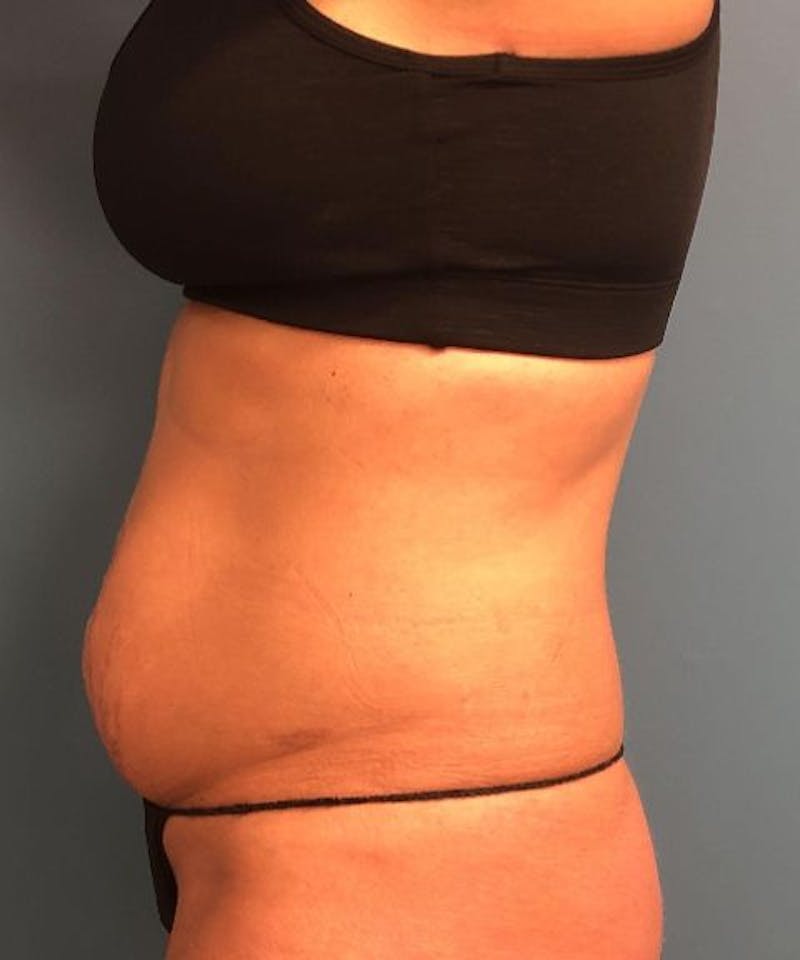 Tummy Tuck Before & After Gallery - Patient 410757 - Image 3