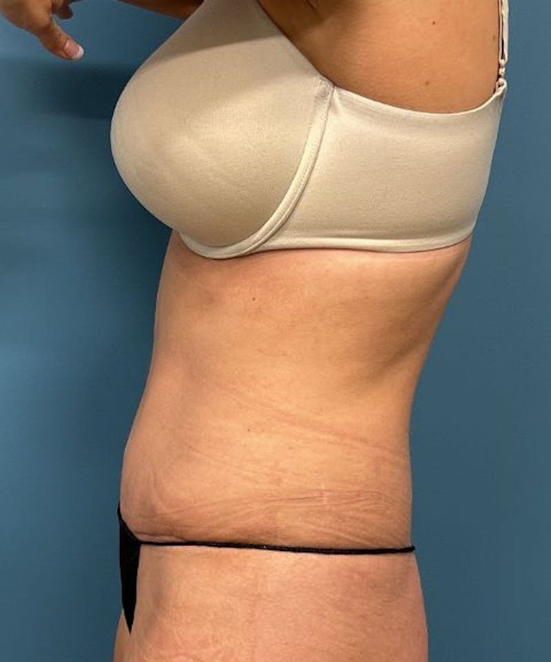 Tummy Tuck Before & After Gallery - Patient 410757 - Image 4