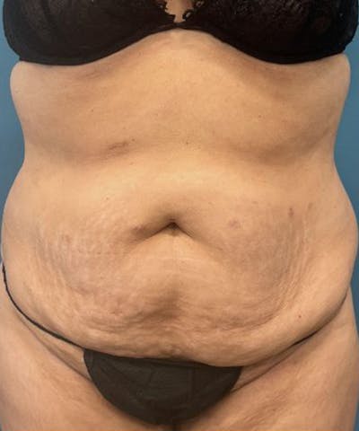 Tummy Tuck Before & After Gallery - Patient 240880 - Image 1