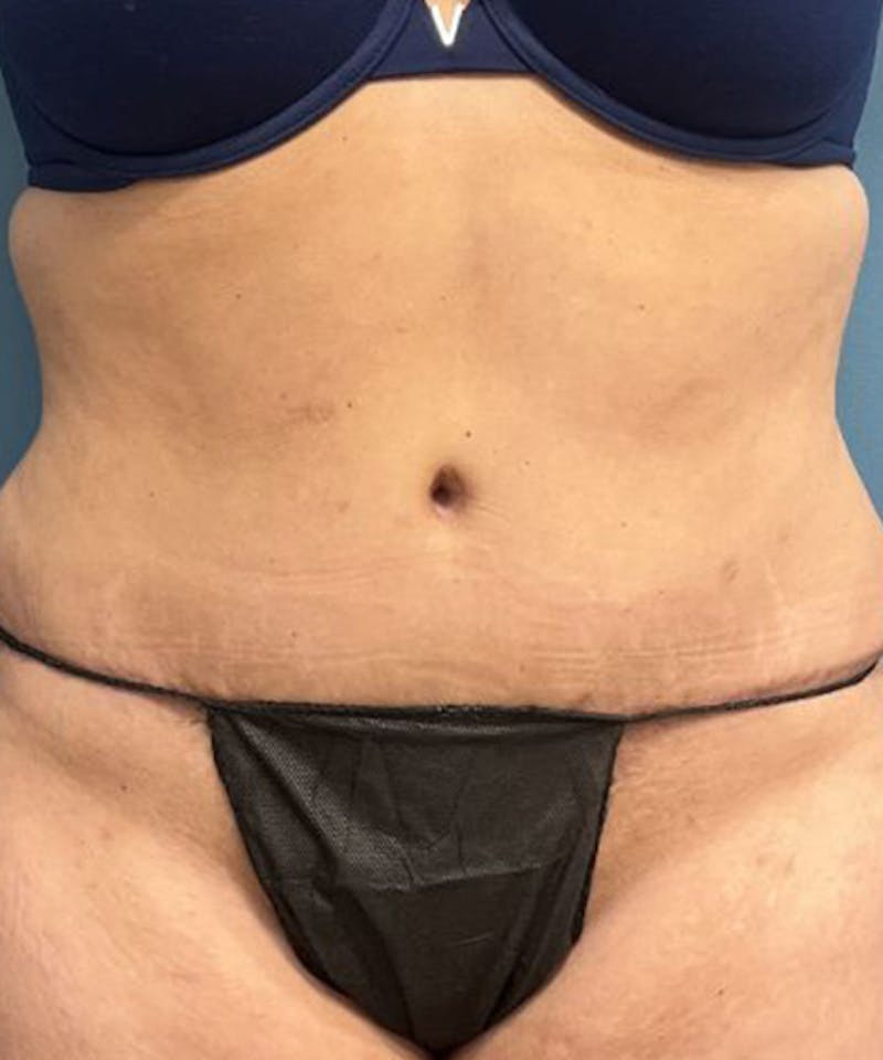 Tummy Tuck Before & After Gallery - Patient 240880 - Image 2