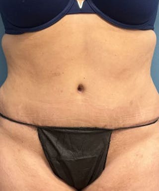 Tummy Tuck Before & After Gallery - Patient 240880 - Image 2