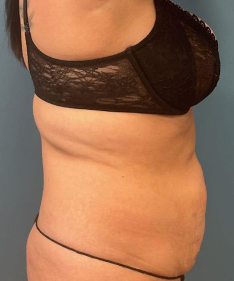 Tummy Tuck Before & After Gallery - Patient 240880 - Image 3
