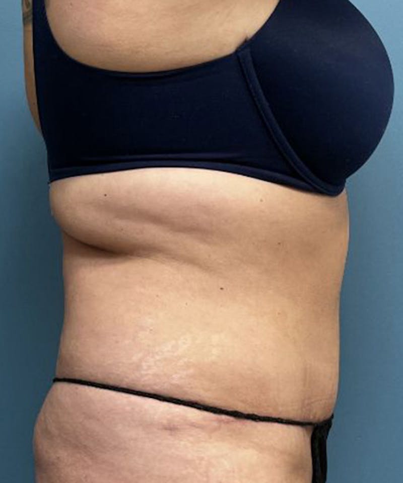 Tummy Tuck Before & After Gallery - Patient 240880 - Image 4