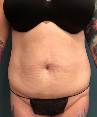 Tummy Tuck Before & After Gallery - Patient 243236 - Image 1