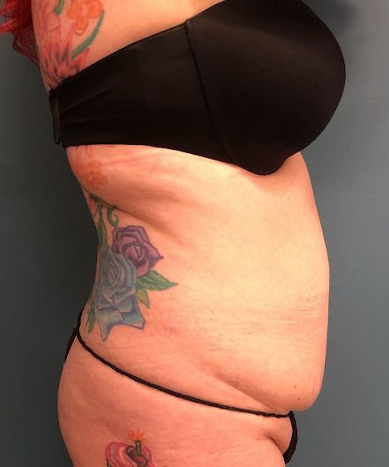 Tummy Tuck Before & After Gallery - Patient 243236 - Image 3