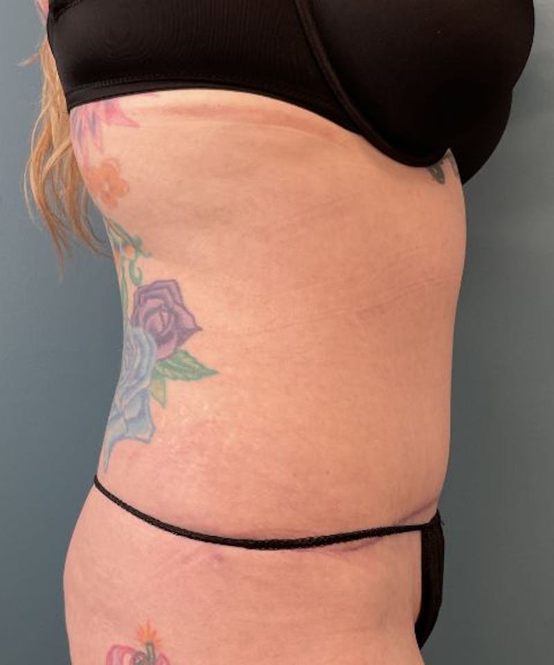 Tummy Tuck Before & After Gallery - Patient 243236 - Image 4