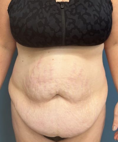 Tummy Tuck Before & After Gallery - Patient 344629 - Image 1