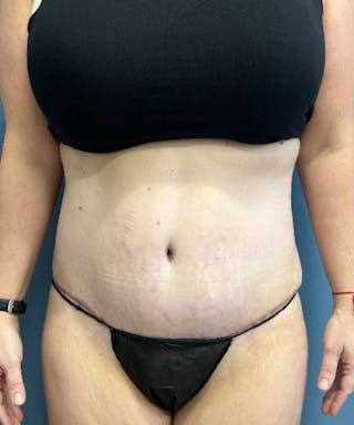 Tummy Tuck Before & After Gallery - Patient 344629 - Image 2