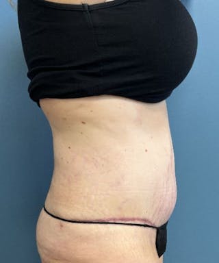 Tummy Tuck Before & After Gallery - Patient 344629 - Image 4