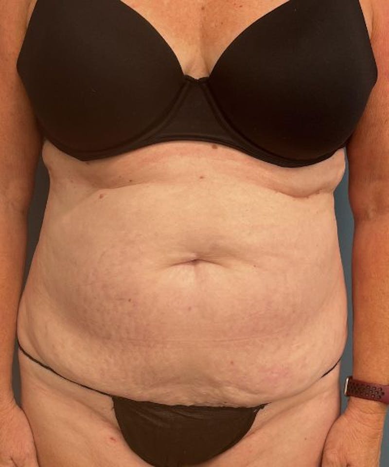 Tummy Tuck Before & After Gallery - Patient 287370 - Image 1