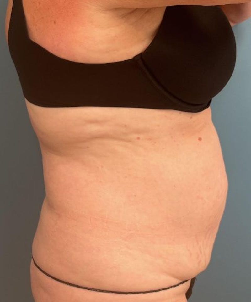 Tummy Tuck Before & After Gallery - Patient 287370 - Image 3