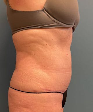 Tummy Tuck Before & After Gallery - Patient 287370 - Image 4