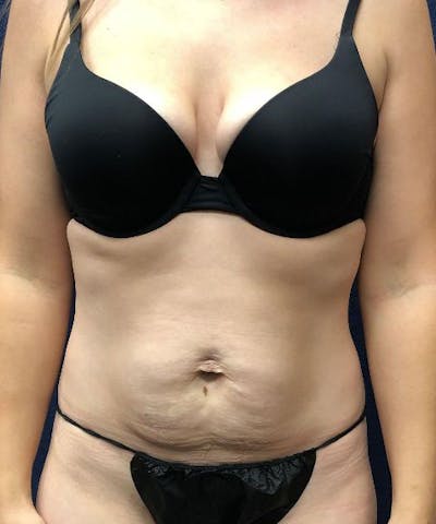 Tummy Tuck Before & After Gallery - Patient 233671 - Image 1