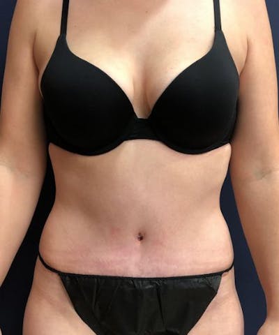 Tummy Tuck Before & After Gallery - Patient 233671 - Image 2