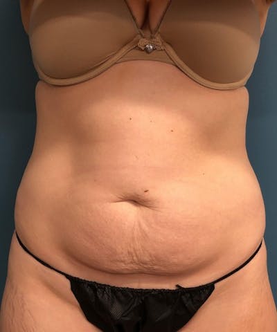 Tummy Tuck Before & After Gallery - Patient 286539 - Image 1