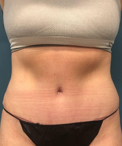 Tummy Tuck Before & After Gallery - Patient 286539 - Image 2