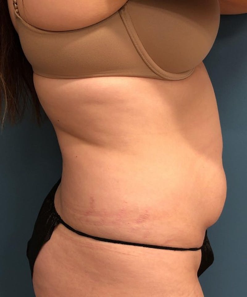 Tummy Tuck Before & After Gallery - Patient 286539 - Image 3