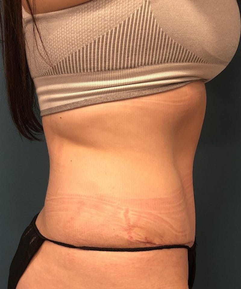 Tummy Tuck Before & After Gallery - Patient 286539 - Image 4