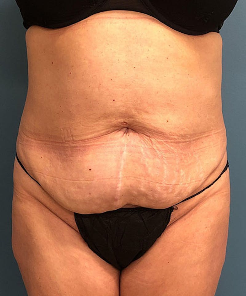 Tummy Tuck Before & After Gallery - Patient 304120 - Image 1