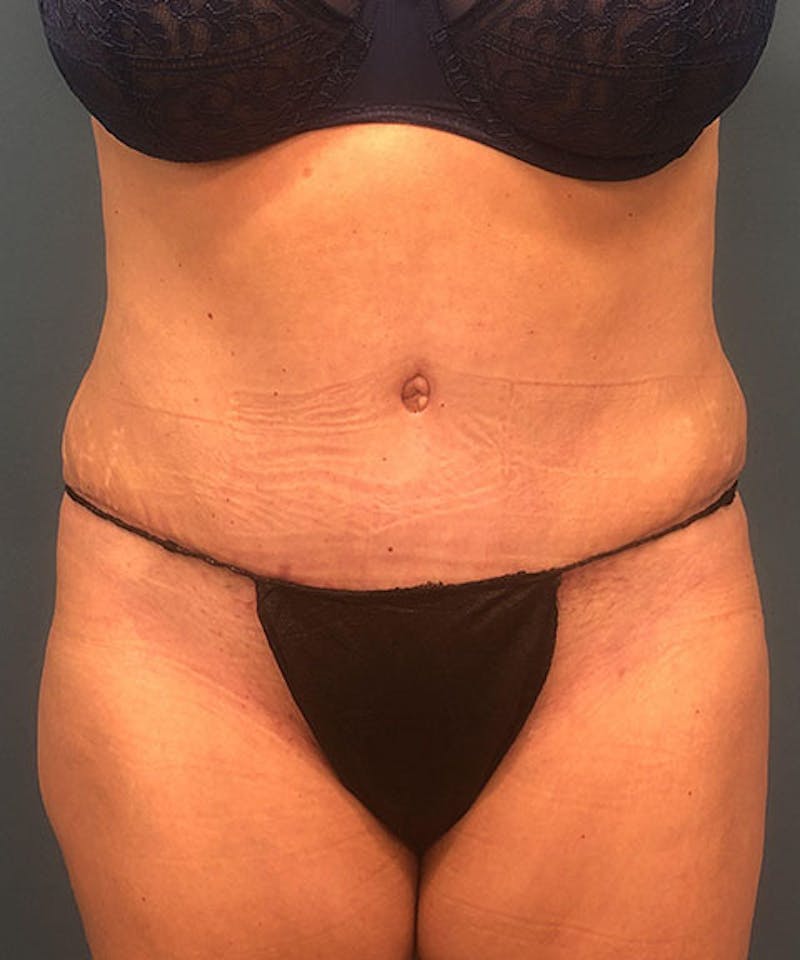 Tummy Tuck Before & After Gallery - Patient 304120 - Image 2