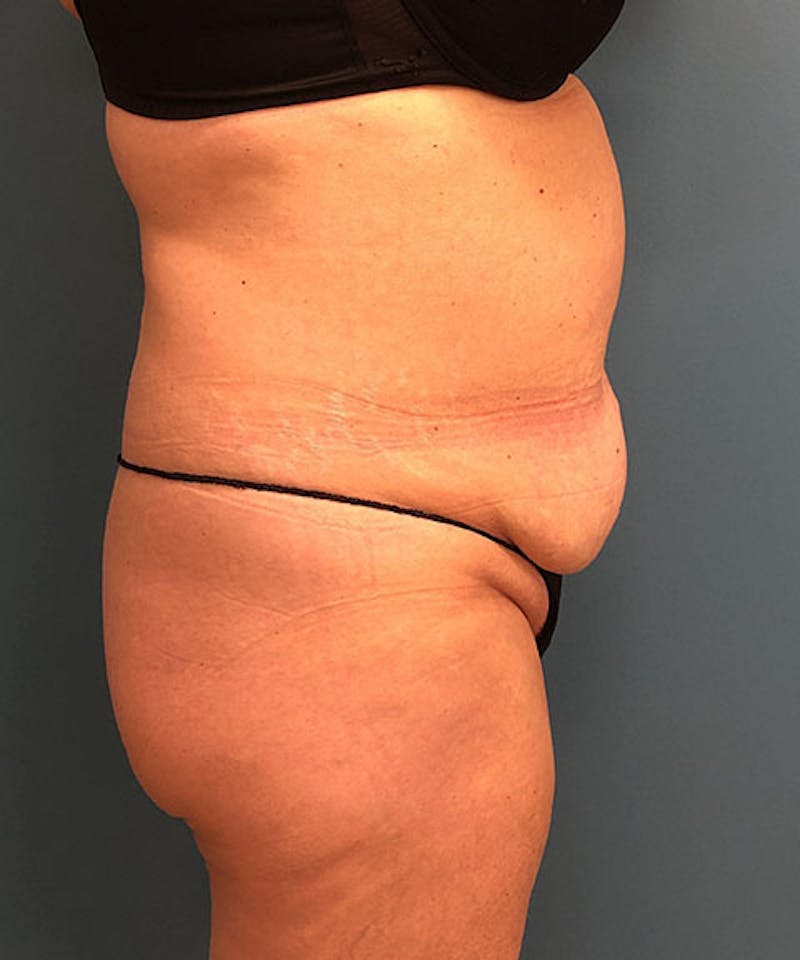 Tummy Tuck Before & After Gallery - Patient 304120 - Image 3