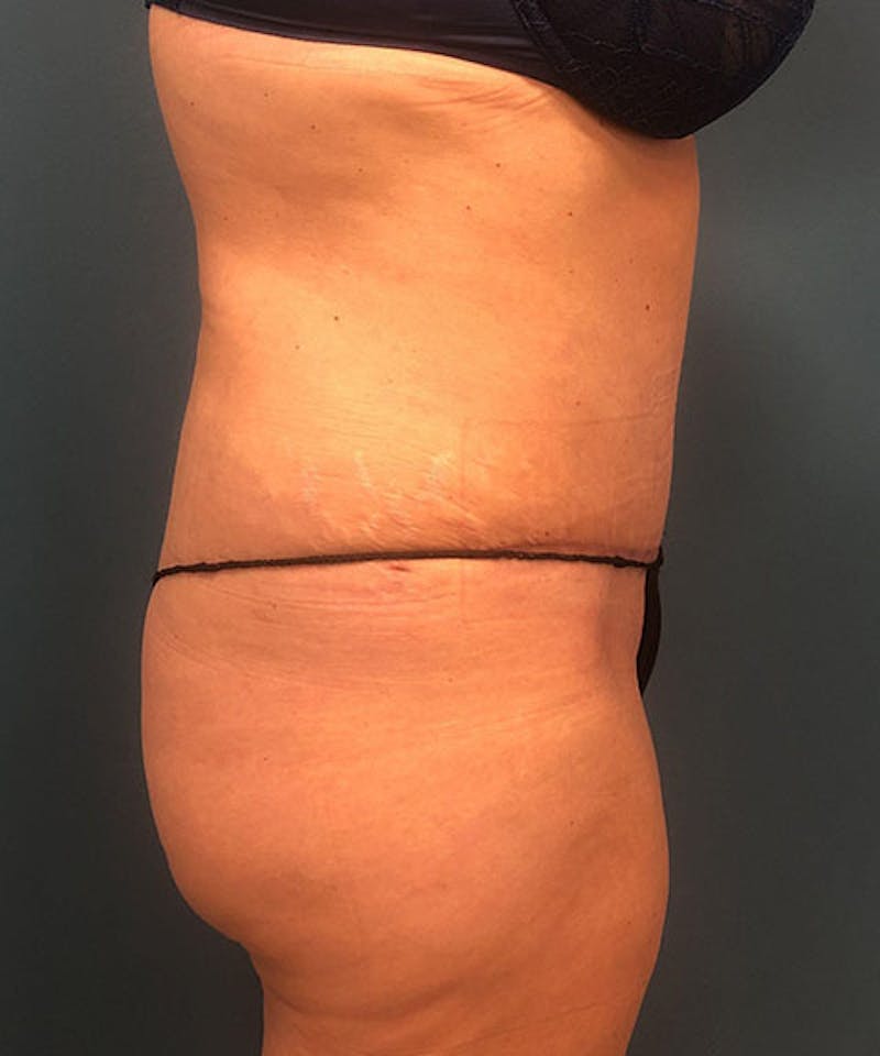 Tummy Tuck Before & After Gallery - Patient 304120 - Image 4