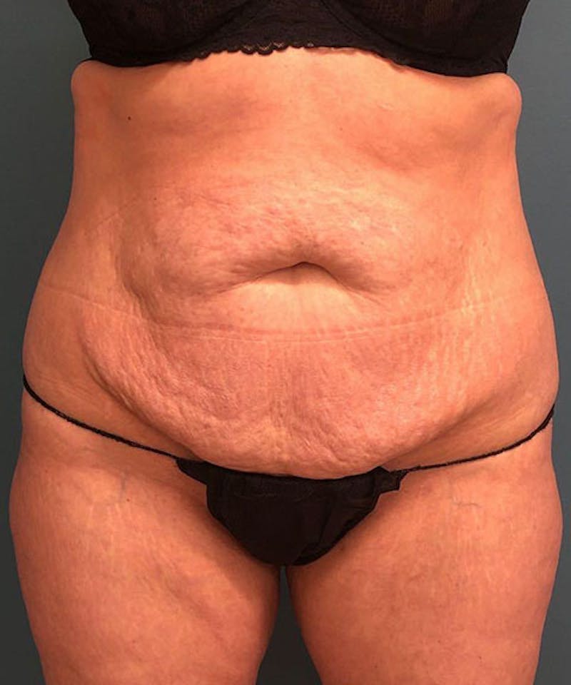 Tummy Tuck Before & After Gallery - Patient 340503 - Image 1