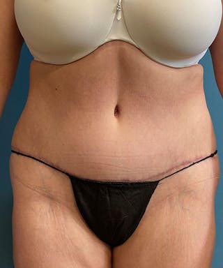 Tummy Tuck Before & After Gallery - Patient 340503 - Image 2