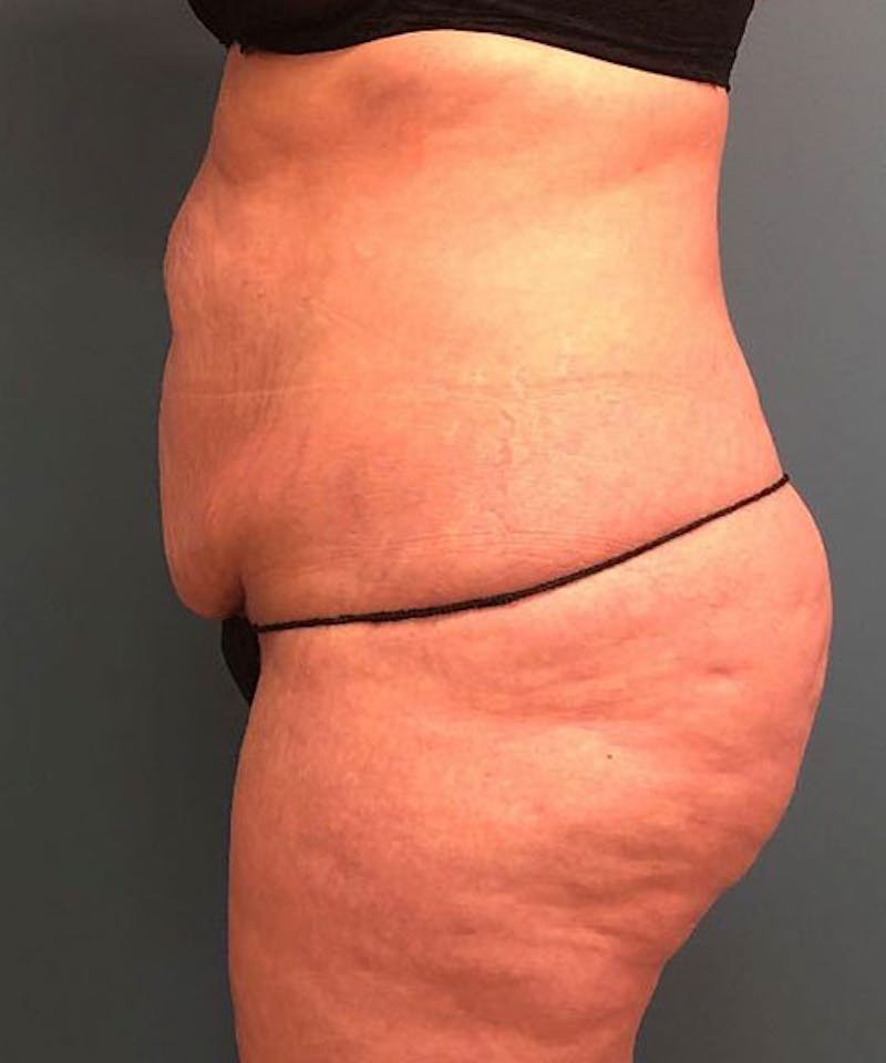 Tummy Tuck Before & After Gallery - Patient 340503 - Image 3
