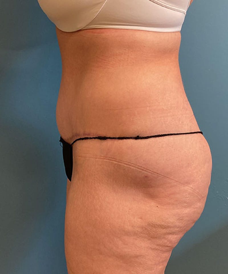 Tummy Tuck Before & After Gallery - Patient 340503 - Image 4