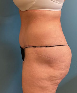 Tummy Tuck Before & After Gallery - Patient 340503 - Image 4