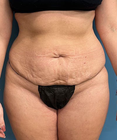 Tummy Tuck Before & After Gallery - Patient 234999 - Image 1