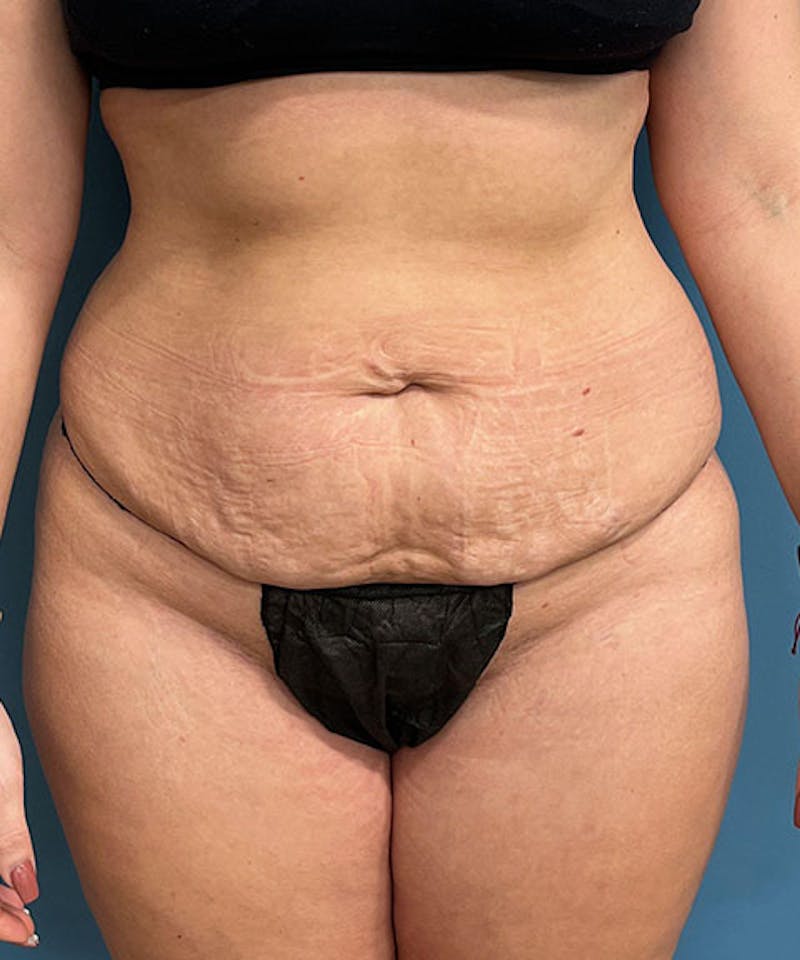 Tummy Tuck Before & After Gallery - Patient 234999 - Image 1