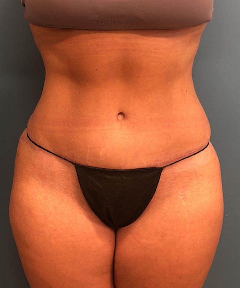 Tummy Tuck Before & After Gallery - Patient 234999 - Image 2