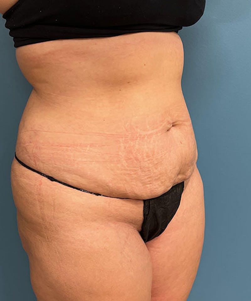 Tummy Tuck Before & After Gallery - Patient 234999 - Image 3