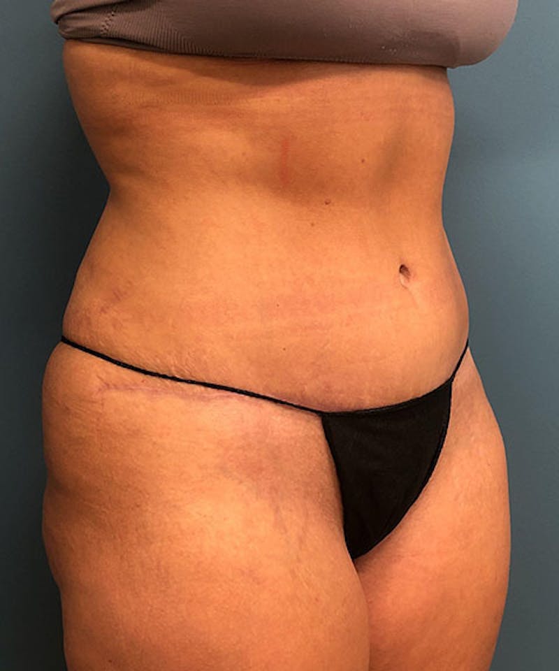 Tummy Tuck Before & After Gallery - Patient 234999 - Image 4