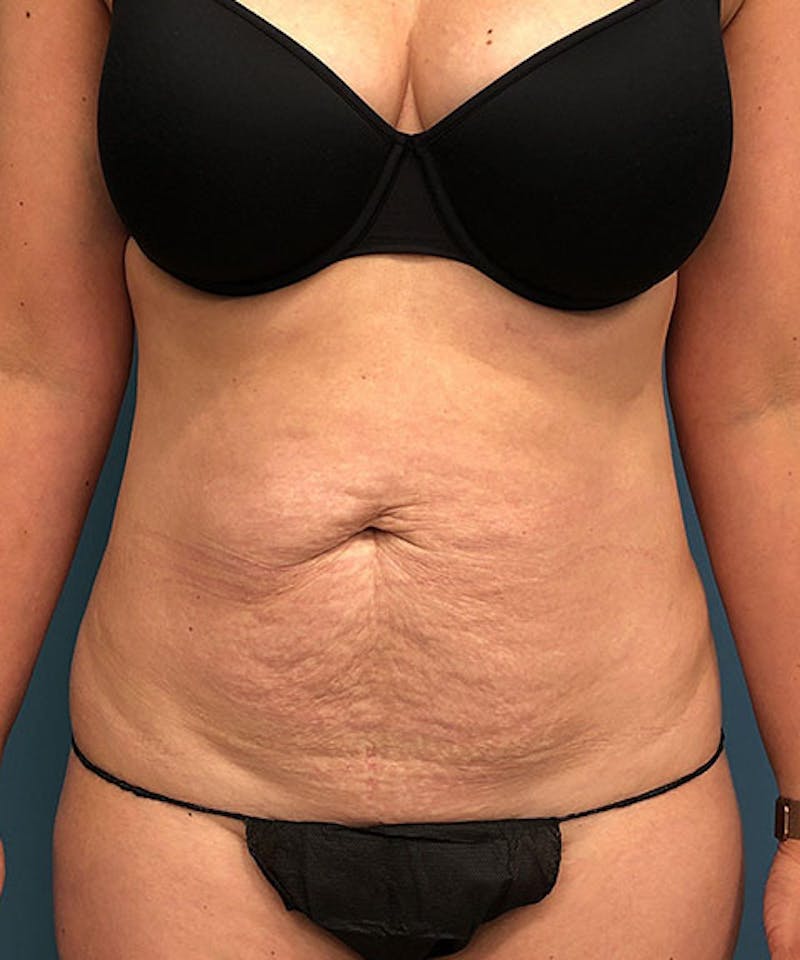 Tummy Tuck Before & After Gallery - Patient 138147 - Image 1