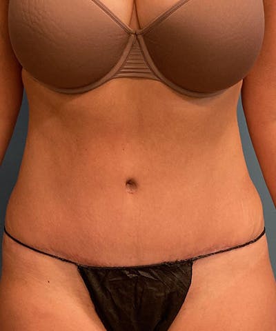 Tummy Tuck Before & After Gallery - Patient 138147 - Image 2