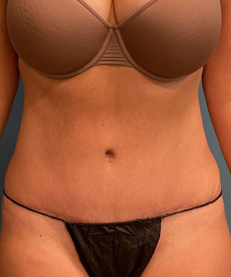 Tummy Tuck Before & After Gallery - Patient 138147 - Image 2