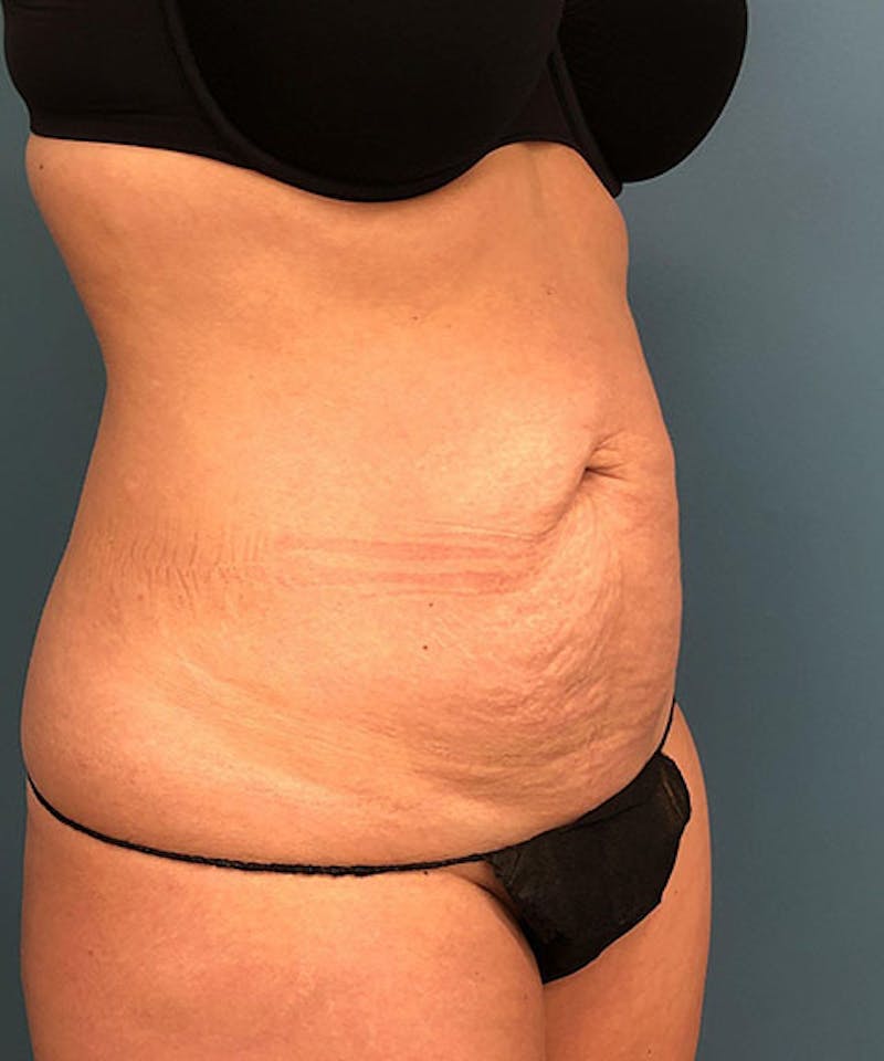 Tummy Tuck Before & After Gallery - Patient 138147 - Image 3