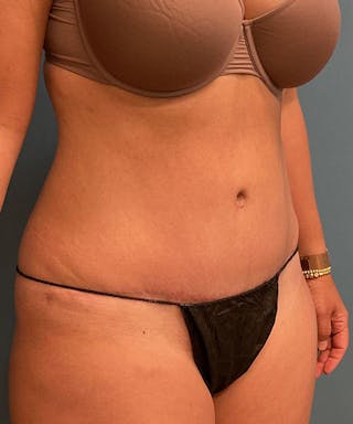 Tummy Tuck Before & After Gallery - Patient 138147 - Image 4