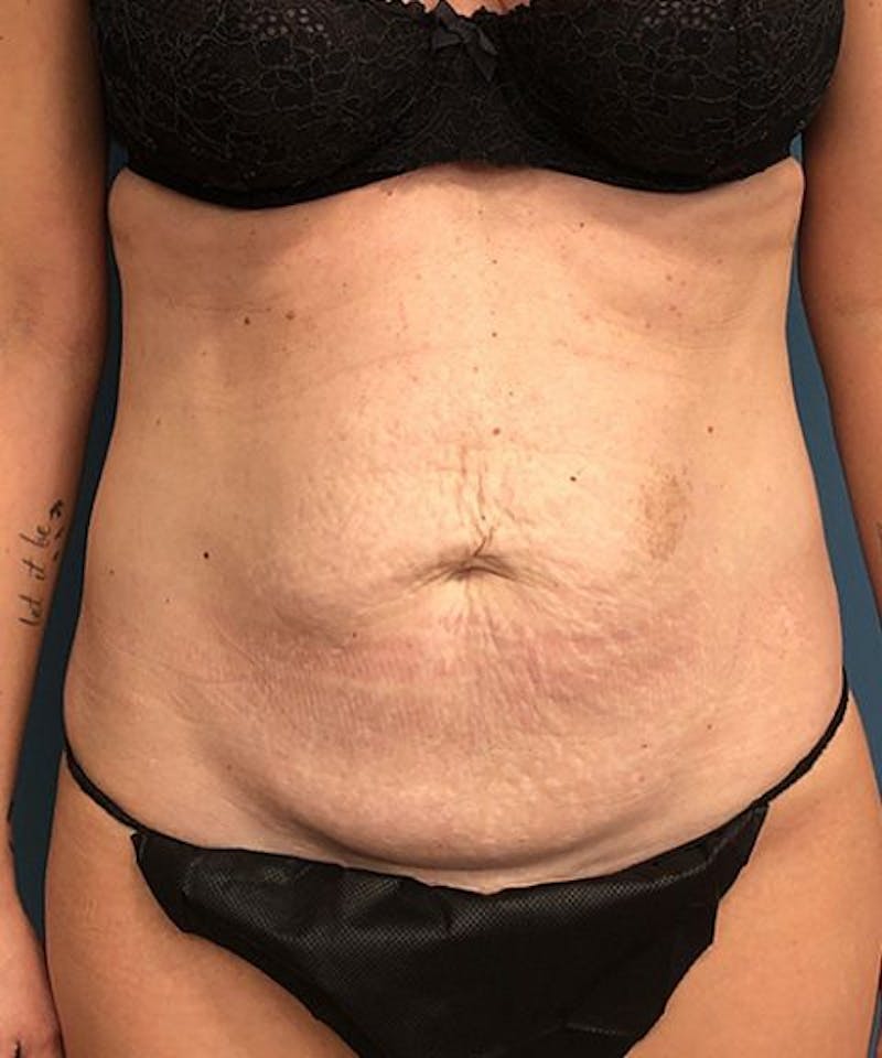 Tummy Tuck Before & After Gallery - Patient 395386 - Image 1