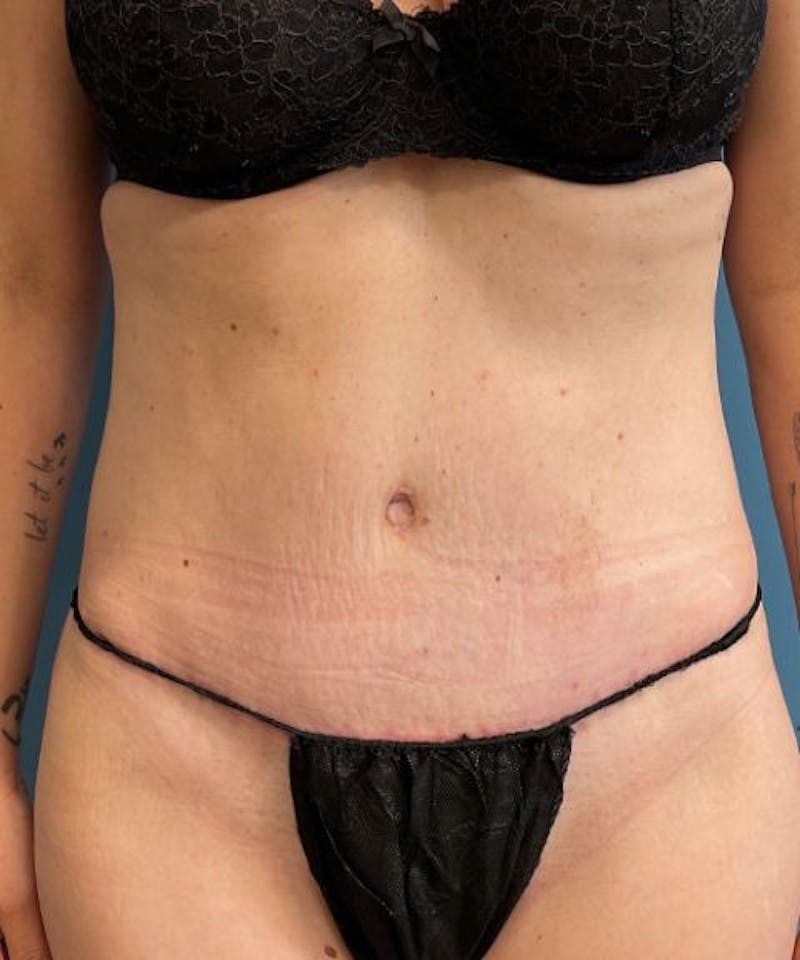 Tummy Tuck Before & After Gallery - Patient 395386 - Image 2