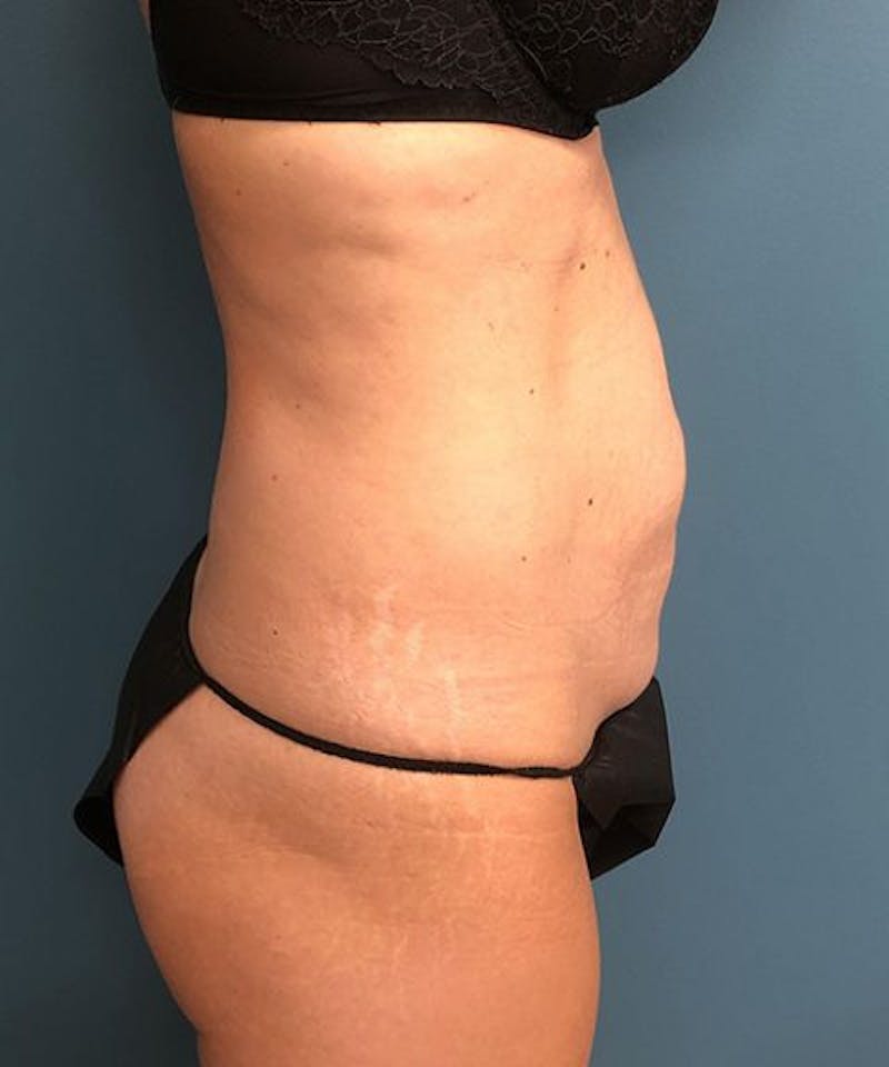 Tummy Tuck Before & After Gallery - Patient 395386 - Image 3