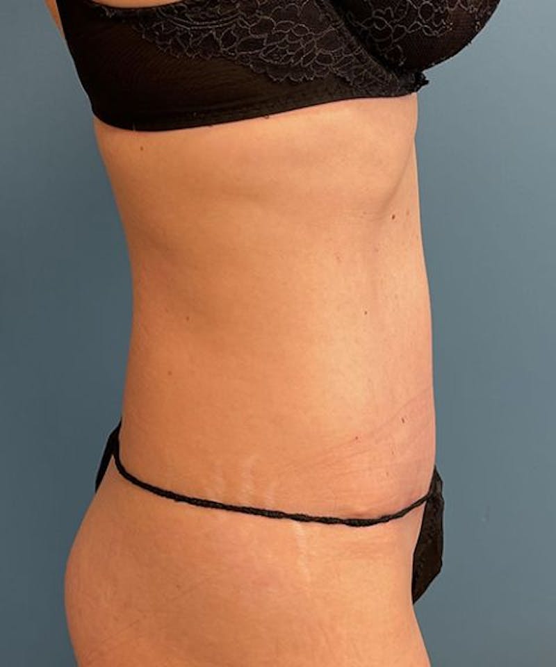 Tummy Tuck Before & After Gallery - Patient 395386 - Image 4