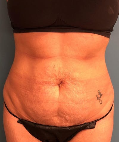 Tummy Tuck Before & After Gallery - Patient 189620 - Image 1